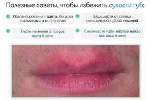 Иллюстрация к записи «Проверенные способы для лечения потрескавшихся губ»
