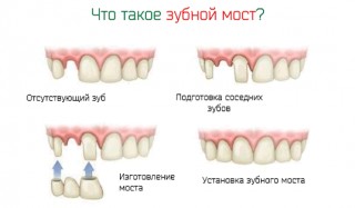 Иллюстрация к записи «Восстановление отсутствующих зубов с помощью мостов протезирования»