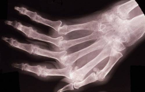 Рентгеновский снимок кисти руки – артрит
