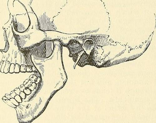 Смещение челюсти при вывихе сустава
