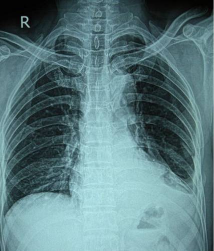 Рентген грудной клетки при переломе ребер