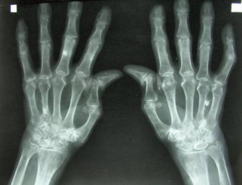 Ревматоидный артрит - рентгеновский снимок рук
