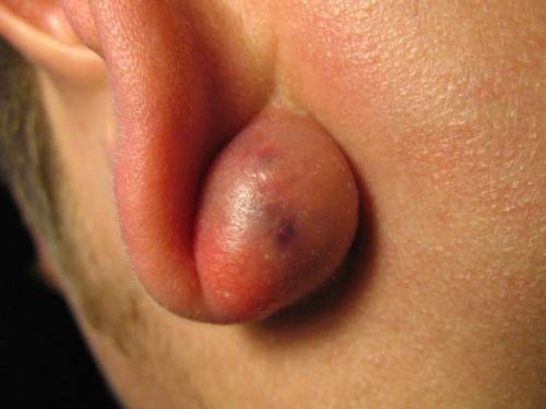 Атерома (киста) мочки уха