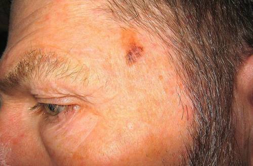 Меланома (рак кожи) на голове