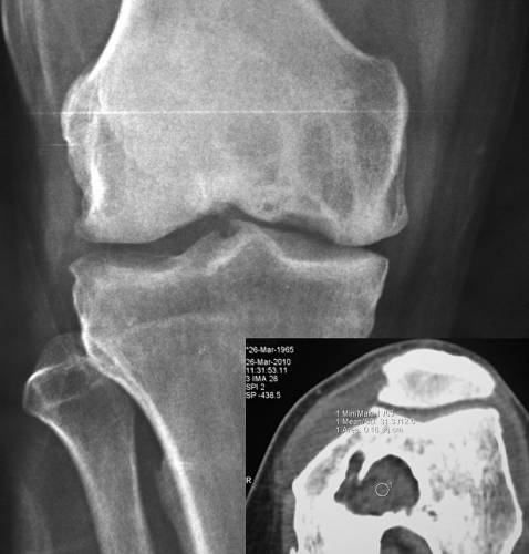 Рентген колена с гигантоклеточной опухолью