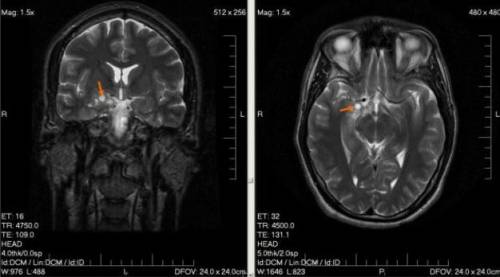 Глиома в мозге мужчины (компьютерная фотография)