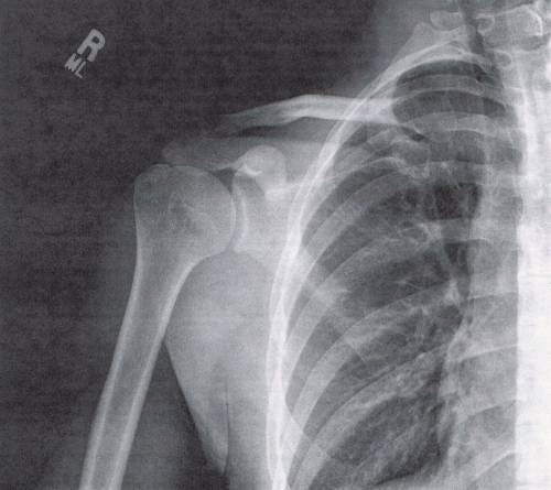 Рентгеновский сником при переломе плеча
