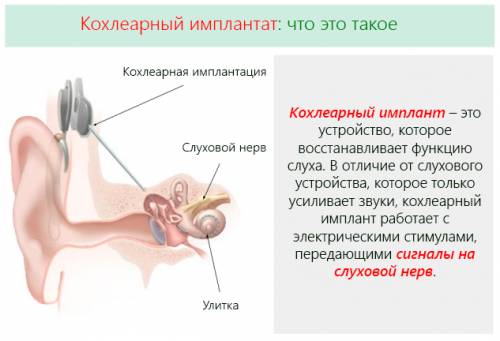 Кохлеарный имплант для восстановления слуха