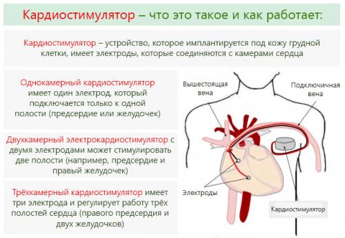 Основные виды и принципы работы кардиостимулятора