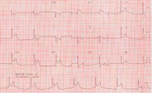 Инфаркт желудочков миокарда: кардиограмма