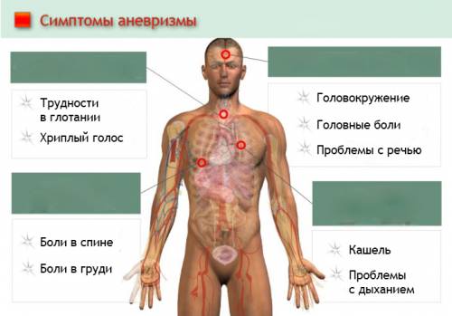 Симптомы аневризмы кровеносных сосудов
