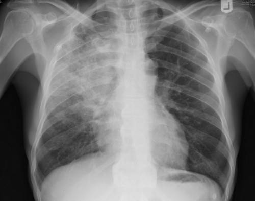 Рентгеновский снимок при обструктивной пневмонии