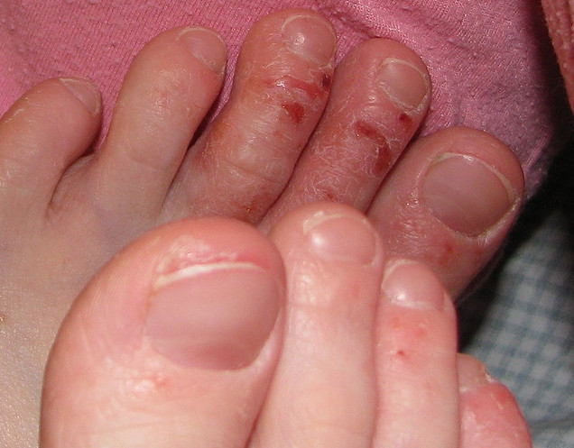 Причины атопического дерматита кожи – возможное лечение