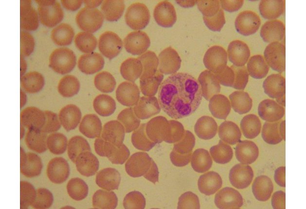 Агранулоцитоз – отсутствие гранулоцитов нейтрофилов в периферической крови