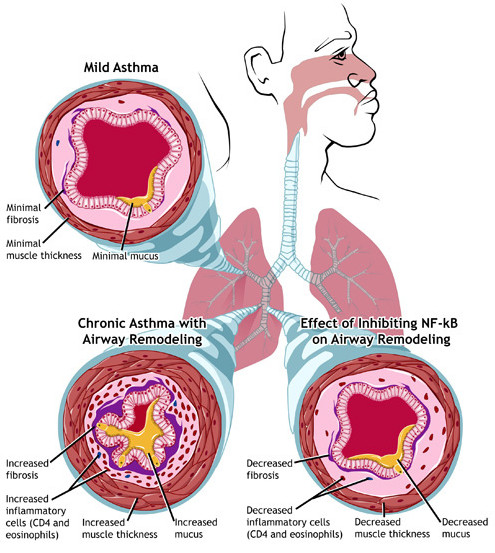 Почему случаются приступы бронхиальной астмы