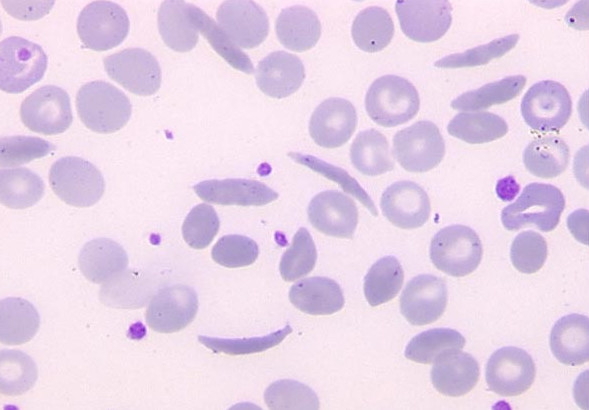 Как на здоровье влияет серповидно-клеточная анемия