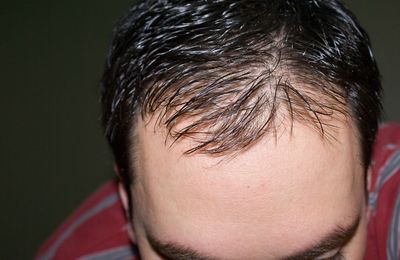 Характерные симптомы начала облысения и выпадения волос