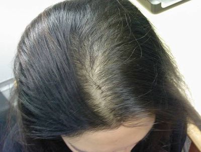 Причины диффузного облысения – женское выпадение волос