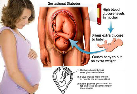 Гестационный диабет – особенности лечения и влияние на развитие плода