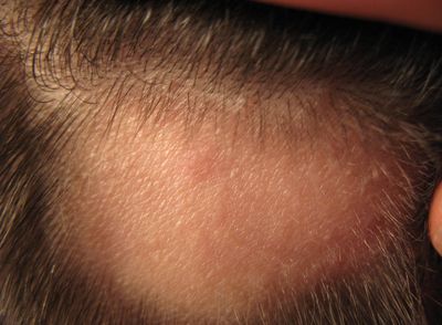 Почему выпадают волосы на небольших участках головы и тела