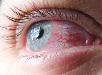 Бактериальный и грибковый кератит – лечение воспаления роговицы глаза