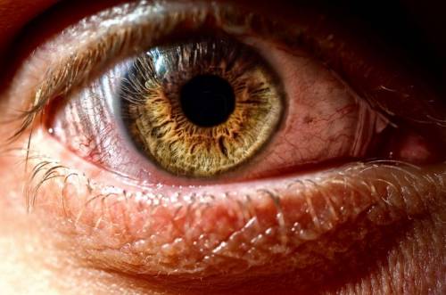 Ксерофтальмия – причины и лечение синдрома сухого глаза