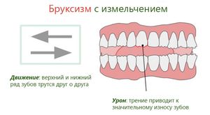 Последствия бруксизма у детей и взрослых – зависят от причин скрежетания зубами