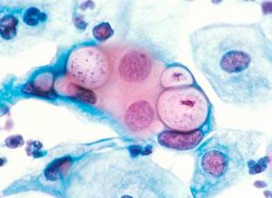 Результат исследования на антитела к бактерии Chlamydia – что означают