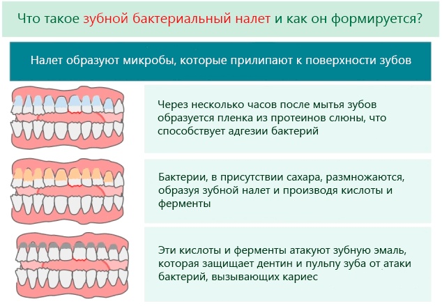 Как полностью избавиться от бактериального налета на зубах