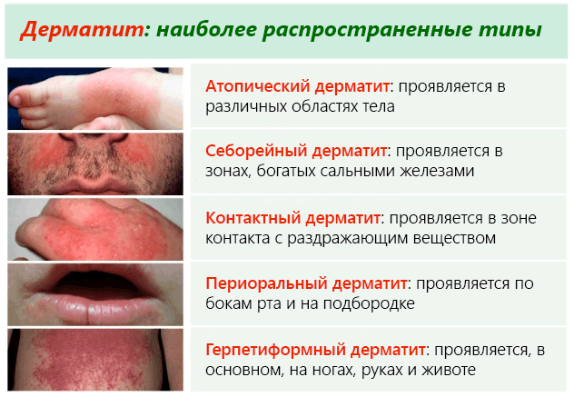 Атопический, себорейный, герпетиформный и периоральный дерматит кожи