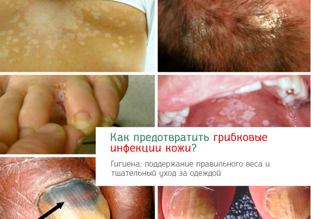Грибковые инфекции на коже – чем отличаются и какие средства помогут