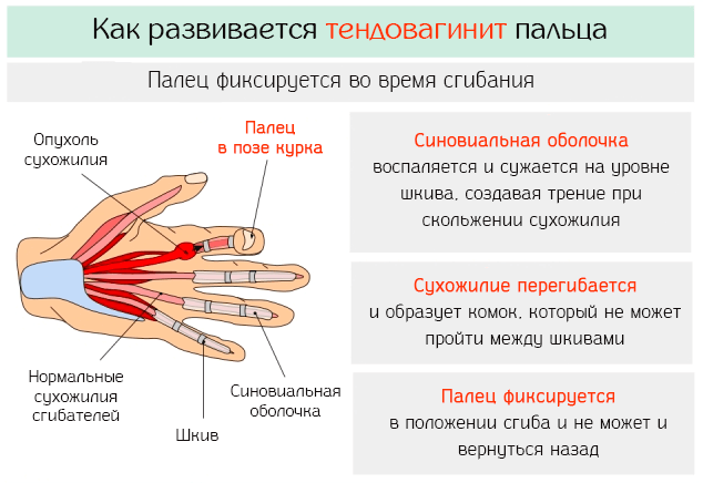 Причина воспаления синовиальной оболочки сухожилий пальца и методы восстановления
