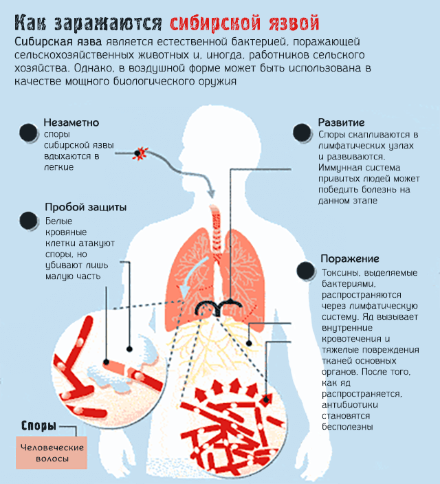 Как можно заразиться сибирской язвой – симптомы и лечение