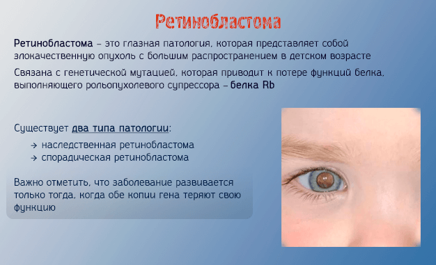Как проявляется ретинобластома на глазах – методы профилактики и лечения