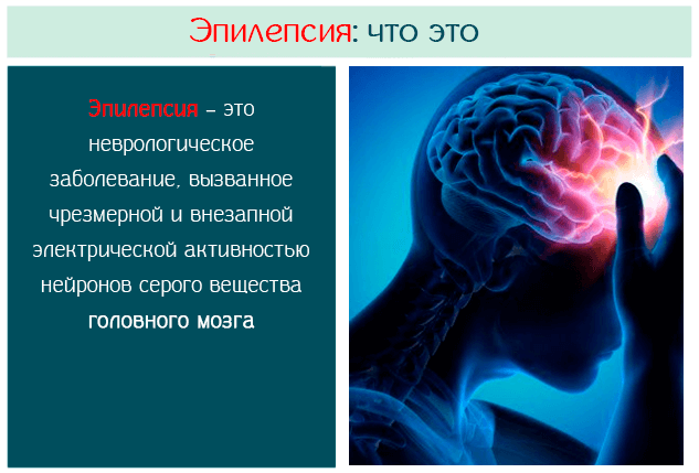 Эпилепсия – это неврологическое заболевание, вызванное чрезмерной и внезапной электрической активностью нейронов