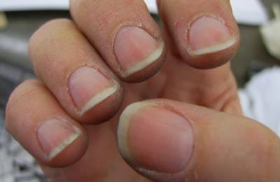 Иллюстрация к записи «Что поможет избавиться от трещин кожи вокруг ногтей»