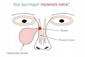 Иллюстрация к записи «Чем опасны носовые полипы – когда их нужно удалять»