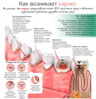 Иллюстрация к записи «Симптомы гангрены зуба – чем грозит воспаление пульпы зуба»
