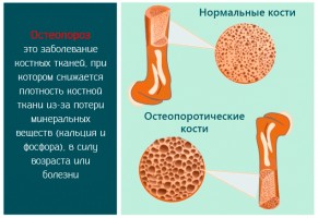 Иллюстрация к записи «Профилактика остеопороза для мужчин – 3 главных шага к полному здоровью»