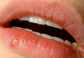 Иллюстрация к записи «Заражение вирусом герпеса – секреты лечения воспаления на губах»