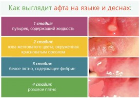 Иллюстрация к записи «Как лечить изъязвления в полости рта»