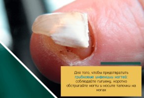 Иллюстрация к записи «Онихомикоз – секреты профилактики грибковых заболеваний ногтей»