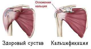 Иллюстрация к записи «Тендиноз сухожилий сустава с отложением кальция – как его лечить»