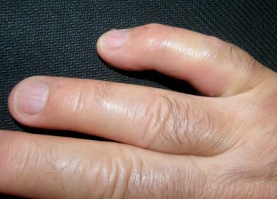 Почему опух палец на руке