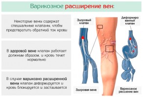 Иллюстрация к записи «Методы профилактики варикозного расширения вен ног – лечение язв и»