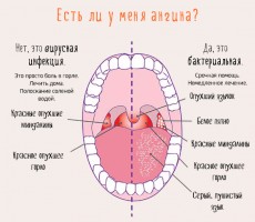 Иллюстрация к записи «Заражение горла стрептококком – симптомы и лечение»