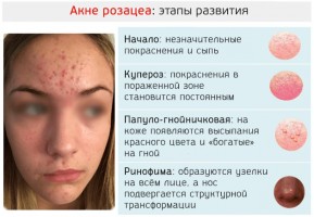 Иллюстрация к записи «Купероз на лице – причина и устранения мелких сосудов на поверхности кожи»