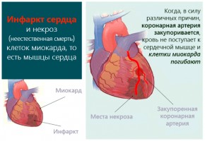 Иллюстрация к записи «Последствия ишемии миокарда – как проявляется гипоксия сердца»