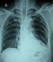 Иллюстрация к записи «Рентген легких – как подготовиться к рентгену и что покажет снимок»