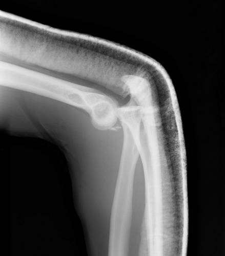 Вывих локтевого сустава – рентгеновский снимок